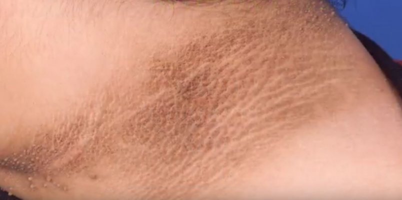 acanthosis-nigricans-1000x0