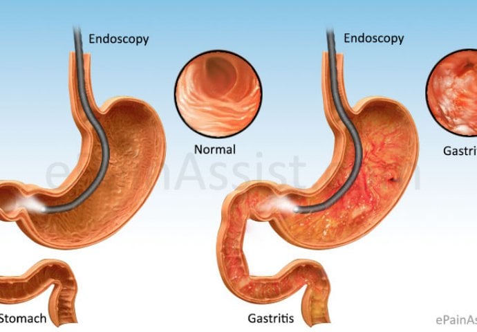 NJEMAČKI DOKTOR OTKRIO NAJBOLJI LIJEK ZA GASTRITIS: Ova smjesa čini čuda!