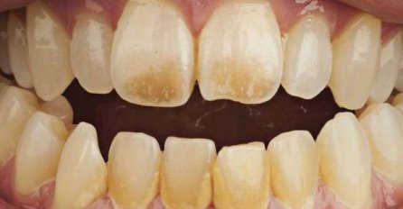 GENIJALAN TRIK ZA BIJELE ZUBE, BIT ĆE SAVRŠENI: Nećete ni sami vjerovati 