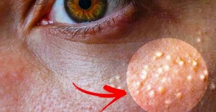 Ako imate bijele tačkice oko očiju NI SLUČAJNO IH NE 'ISTISKUJTE': Evo kako da ih se riješite