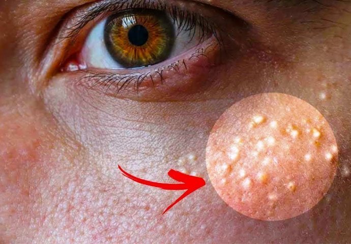 Ako imate bijele tačkice oko očiju NI SLUČAJNO IH NE 'ISTISKUJTE': Evo kako da ih se riješite