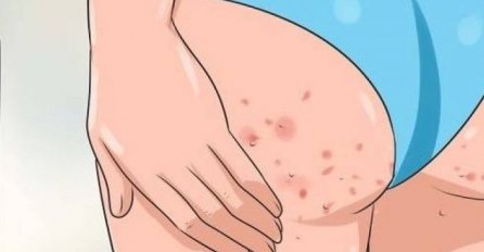 AKNE NA STRAŽNICI NISU NIMALO BEZAZLENE: Ako se pojave, ZNAČI DA IMATE PROBLEM KOJI POGAĐA VELIKI BROJ ŽENA!