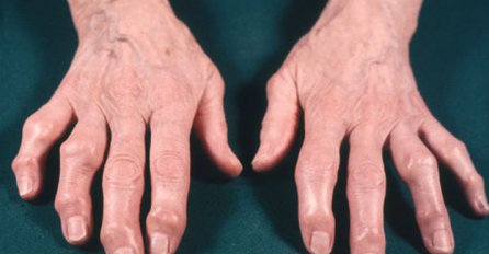 GLAVNI UZROK REUMATOIDNOG ARTRITISA NALAZI SE U VAŠEM FRIŽIDERU: Odmah izbacite ovu namirnicu DOK NIJE KASNO!