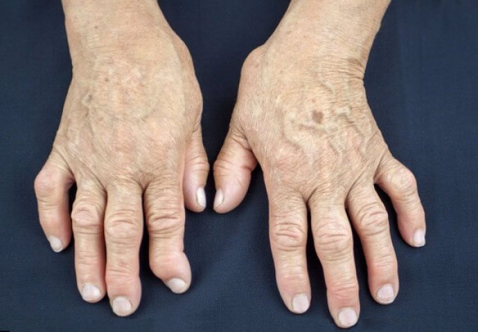 artritis dijeta i liječenje