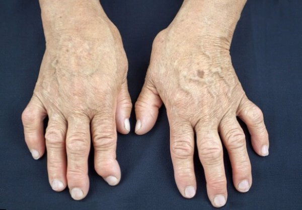 reumatoidni-artritis-1