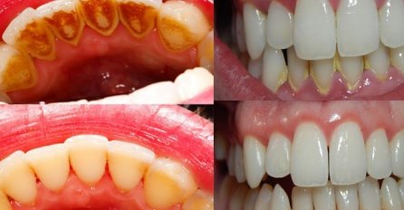 PLAK SA ZUBI uklonite u svom domu za samo 5 minuta: NE MORATE IĆI ZUBARU!