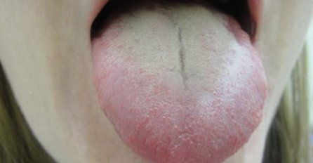 IMATE LI OVE BIJELE NASLAGE NA JEZIKU? Doktori upozoravaju, ovo je simptom OPASNOG STANJA KOJE POGAĐA I MUŠKARCE I ŽENE!