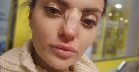 Ella Dvornik završila na hitnoj ''razbijenog'' nosa: Kad čujete šta joj se desilo NEĆETE VJEROVATI!