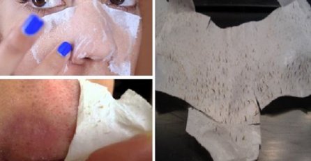 OVA DVA SASTOJKA IZVLAČE I NAJDUBLJE MITESERE: Za 10 minuta NESTAJU SVE NEČISTOĆE! (RECEPT)