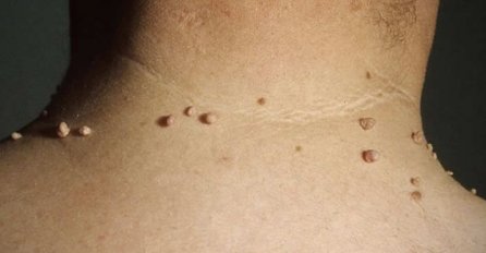 "OVO MI JE POMOGLO KOD SITNIH BRADAVICA NA KOŽI" Koristila sam samo ovaj sastojak i uspjele su nestati (RECEPT)