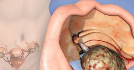 SPRJEČAVA RAK JAJNIKA, A SVI GA IMAMO U KUĆI: Ovaj lijek ženama spašava život!