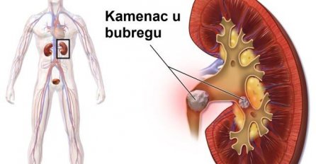 Znakovi upozorenja da možda imate bubrežni kamenac