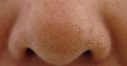 NERVIRALI SU ME MITESERI NA NOSU, A ONDA SAM OTKRILA OVAJ TRIK: Zauvijek su nestali i više se NISU VRAĆALI