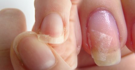 DA LI VAM NOKTI OVAKO IZGLEDAJU? Doktori upozoravaju, EVO ŠTA SE DOGAĐA U VAŠEM ORGANIZMU!