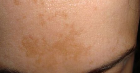 IMATE LI OVE BIJELE FLEKE PO KOŽI? NE IGRAJTE SE: Evo šta je u pitanju!