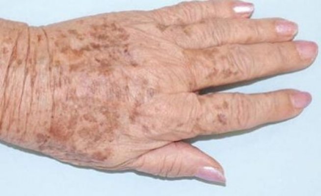 age-spots-on-hands-removal-hand-skin-rejuvenation-big