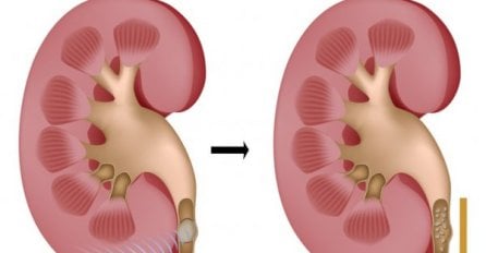 AKO IMATE KAMEN U BUBREGU, OVAJ RECEPT ĆE VAS SPASITI: Sve što vam treba imate u kuhinji, a KAMENCI ĆE SAMI IZLAZITI!
