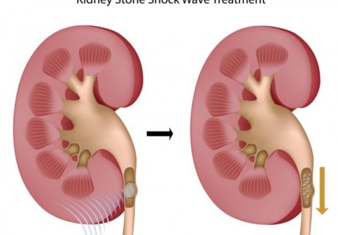 AKO IMATE KAMEN U BUBREGU, OVAJ RECEPT ĆE VAS SPASITI: Sve što vam treba imate u kuhinji, a KAMENCI ĆE SAMI IZLAZITI!