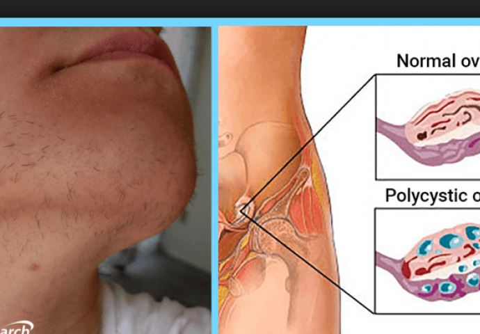 Ovi simptomi ukazuju da imate policistične jajnike: Ako imate navedene znakove što prije posjetite doktora