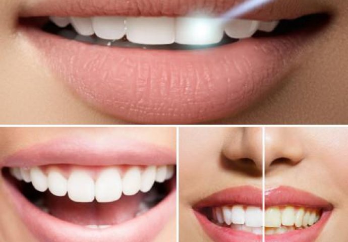 Stomatološka ordinacija 3D misli na Vas! Profesionalno izbjeljivanje zuba uz 70% POPUSTA!