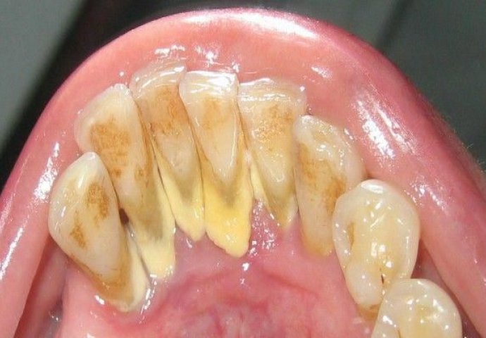 Uklonite RUŽNI KAMENAC SA ZUBI bez odlaska stomatologu: Evo kako ga možete očistiti SAMI I TO ZA 5 MINUTA!