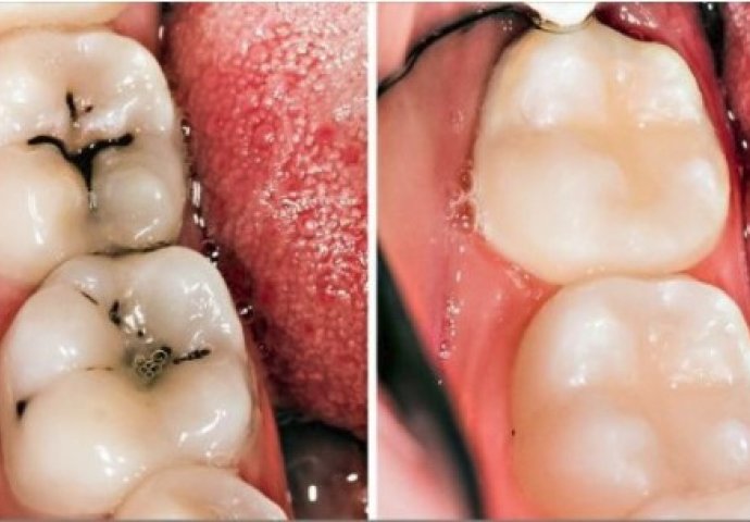 Ovih SEDAM laganih prirodnih načina će vam pomoći da IZLIJEČITE vaše zube