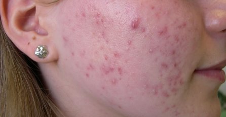 PENZIONISANI DERMATOLOG SVIMA OTKRIO PRAVU ISTINU: Lice će vam biti čisto i bez bubuljica pomoću ovog trika 