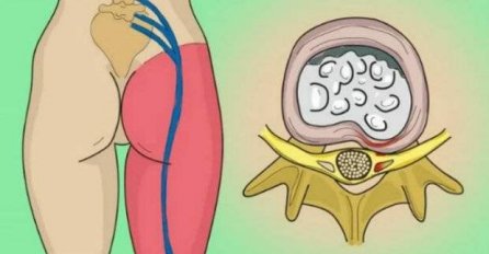 OTKLJEŠTITE UKLJEŠTENI ŽIVAC U LUMBALNOM DIJELU: Dva jednostavna koraka I BOL ZAUVIJEK NESTAJE!