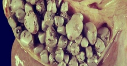 RIJEŠITE SE ŽUČNIH KAMENACA: Potrebna vam je samo JEDNA NAMIRNICA, koju možete kupiti bilo gdje!