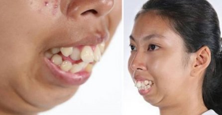 CIJELOG ŽIVOTA SU JE ISMIJAVALI ZBOG RUŽNIH ZUBA: Poslije operacije, niko ne može da vjeruje kako izgleda! (VIDEO)