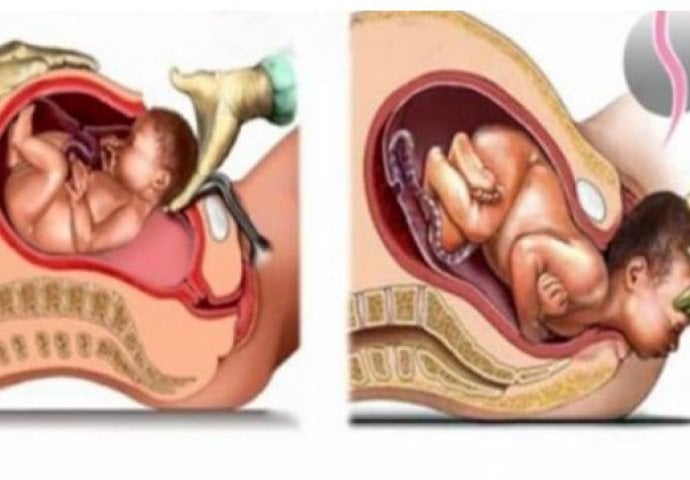 SVAKA ŽENA BI TREBALA OVO ZNATI: Evo koje su razlike između carskog reza i prirodnog poroda