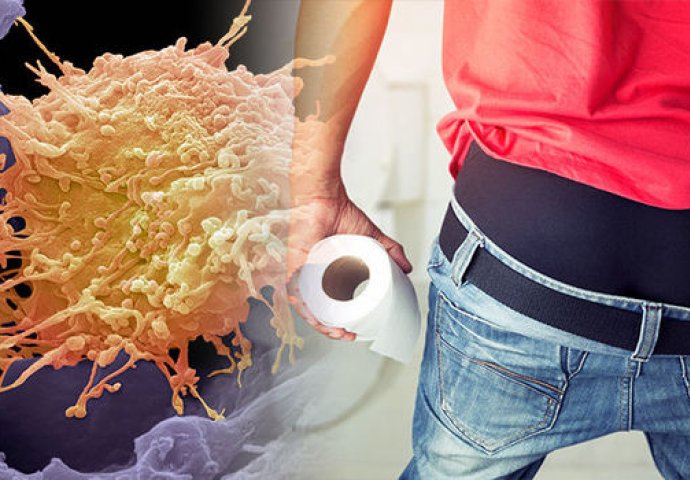 SVAKI DAN RASTE BROJ OBOLJELIH OD RAKA ANUSA: Nikako ne smijete zanemariti OVE simptome