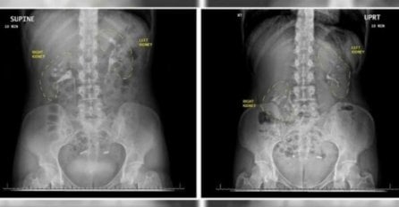 6 GODINA LJEKARE UBIJEĐIVALA DA SE U NJOJ NEŠTO MRDA: Tek kad je zatrudnila, saznala je bolnu istinu