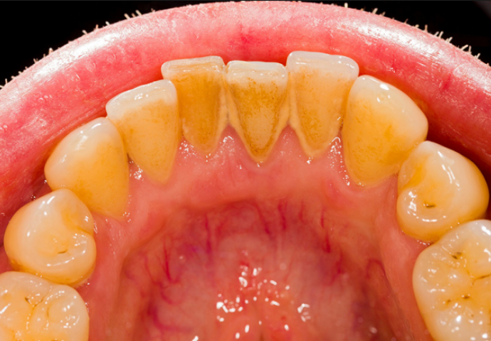 Muči li vas zubni kamenac: Sami ga uklonite za samo 5 minuta, NE TREBATE IĆI ZUBARU