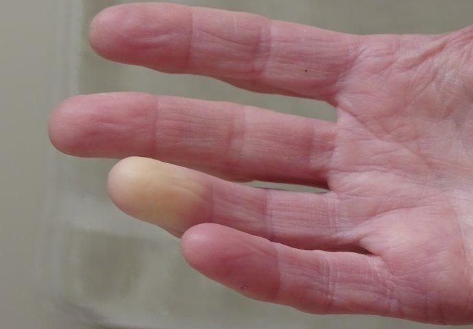 Ruke su vam STALNO HLADNE? To nije ni malo BEZAZLENO, evo na koje bolesti može ukazivati!