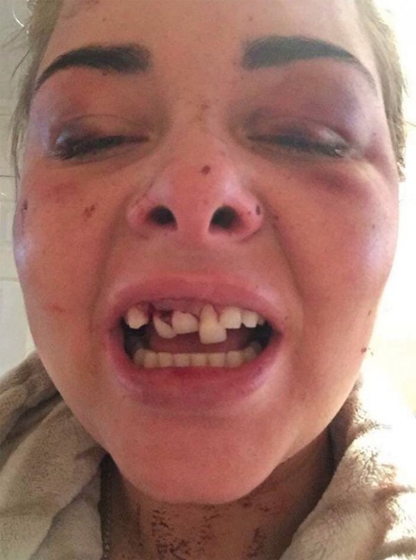 lois-ashton-facebook-picture-broken-jaw-teeth-knocked-out-1539372