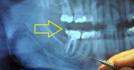 OTRIVENA ŠOKANTNA ISTINA: 97% oboljelih od raka imali su OVAJ ZAHVAT NA ZUBIMA!