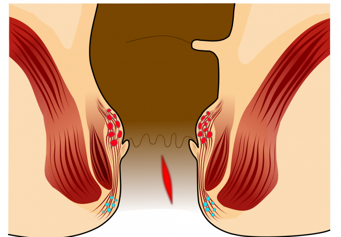 BOLEST KOJE SE SRAMIMO: Evo šta uzrokuje analnu fisuru i kako je liječiti