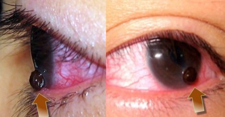 OGLEDALO DUŠE, ALI I ORGANIZMA: Ukoliko primijetite neku od ovih promjena na svojim očima, ogromne su šanse da imate neku od OVIH teških i opakih bolesti