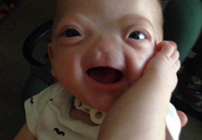 Ova beba je zbog rijetkog genetskog poremećaja rođena bez nosa: Evo kako danas izgleda nakon više desetina operacija