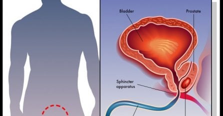 MUŠKARCI OPREZ, OVI SIMPTOMI UKAZUJU NA RAK PROSTATE: Evo kako da prepoznate bolest u začetku!