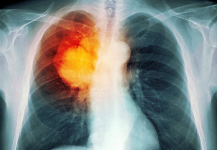 NIJE PUŠENJE: Nećete vjerovati kada saznate šta izaziva RAK pluća
