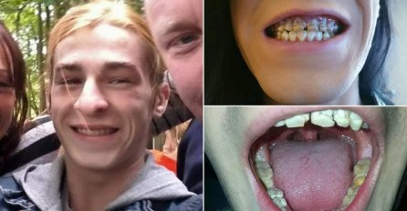 MLADIĆ ZAGRIZAO JABUKU, PA MU PUKLA 4 PREDNJA ZUBA: Ni slučajno ne radite njegovu GREŠKU, ovo se i vama može desiti!
