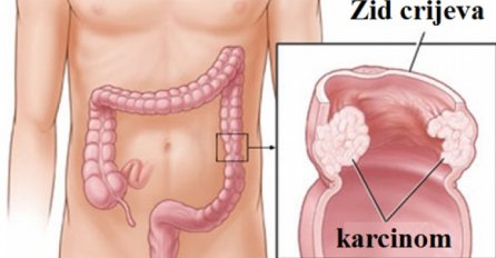 7 PRVIH SIMPTOMA RAKA DEBELOG CRIJEVA: 90% ljudi IGNORIŠE ALARM koji tijelo šalje!