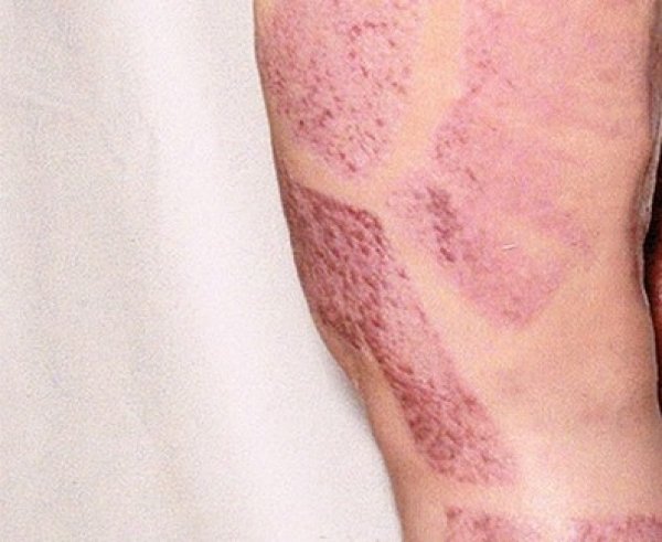 sepsa-noga-profi-media