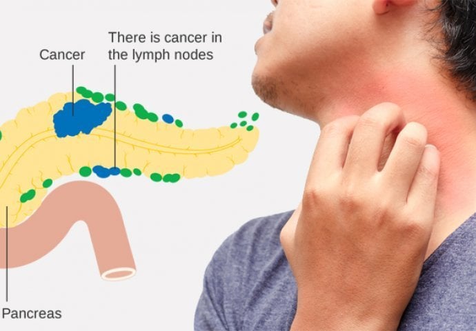 PREPOZNAJTE SIMPTOME RAKA PANKREASA NA VRIJEME: Ne čekajte da bude kasno!