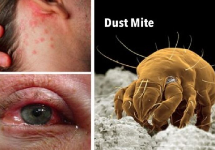 GRINJA I BAKTERIJA MOŽETE SE RIJEŠITI NA SAMO JEDAN NAČIN: Dobro je da znate ovo, DIJELITE DALJE