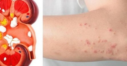 UPOZORAVAJIĆI SIMPTOMI BOLESTI BUBREGA: Neophodno je da ih primijetite na vrijeme!