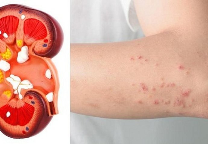 UPOZORAVAJIĆI SIMPTOMI BOLESTI BUBREGA: Neophodno je da ih primijetite na vrijeme!