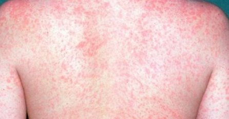 OPREZ! Utrostručio se broj oboljelih od malih boginja